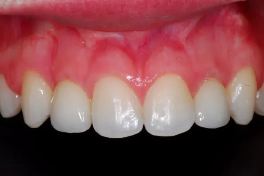 Smile Design - Dental implants Christchurch